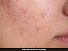 Gharelu Nuskhe: सिर्फ 5 रुपए में पिंपल से मिलेगा छुटकारा, बस करना होगा ये...