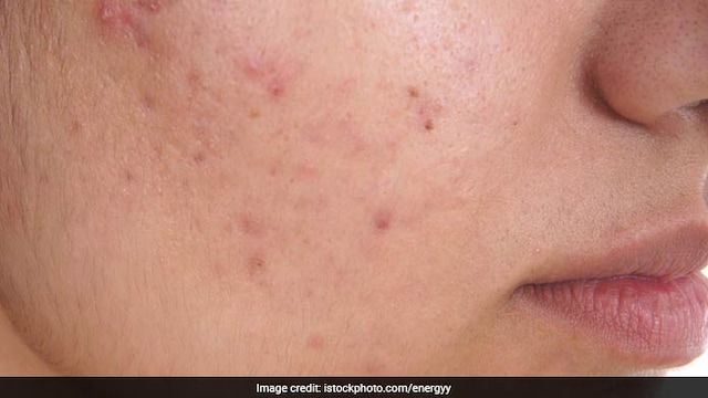 Acne is a chronic inflammatory skin condition which causes pimples and blackheads