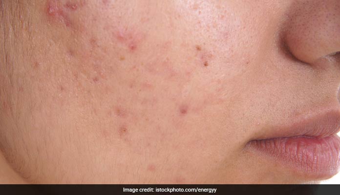 Acne is a chronic inflammatory skin condition which causes pimples and blackheads
