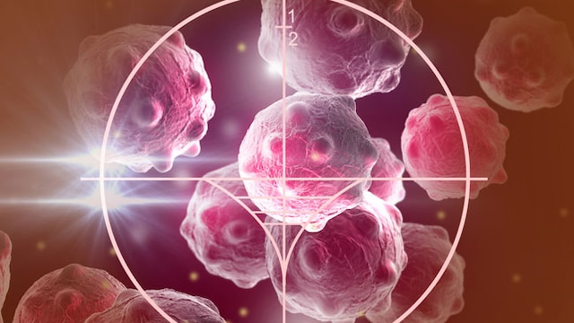 Cancer grows through stages, from 0-4