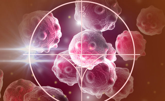 Cancer grows through stages, from 0-4