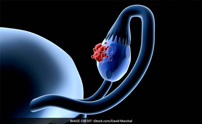 6 Facts You Should Know About Ovarian Cysts