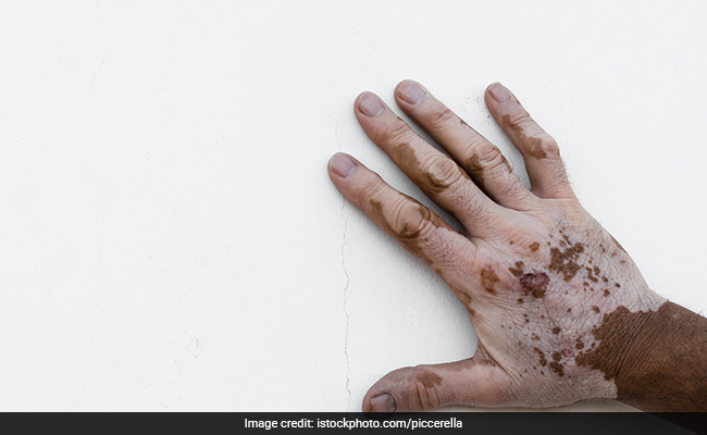 World Vitiligo Day 2018: Vitiligo causes the discoloration of the skin with white spots