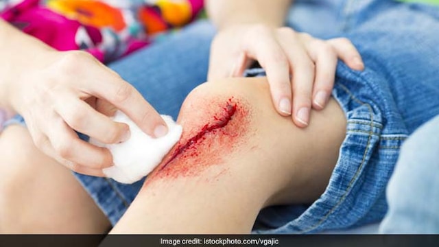 Home remedies for minor cuts including washing the cut immediately to remove dirt and bacteria