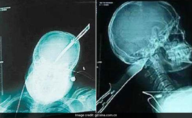 Man Rides Bike To Police Station With A Knife In His Skull, Survives