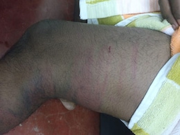 "Beaten By Seniors For 3 Hours," Says Kerala Student From Hospital Bed "Beaten By Seniors For 3 Hours," Says Kerala Student From Hospital Bed