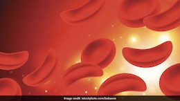 Early Diagnosis Of Sickle Cell Anemia Matters: Newborn Screening And Timely Intervention