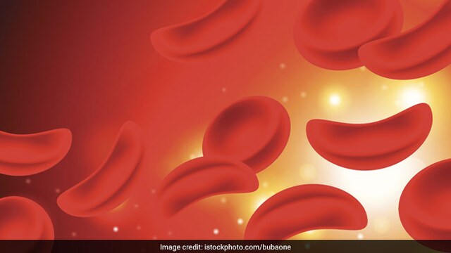 World Sickle Cell Disease Day 2022: Sickle cell disease affects the health of our blood cells