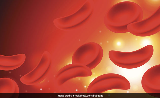 Sickle cell disease: Causes, symptoms and treatment