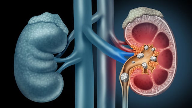 Lack of proper diet and poor lifestyle choices could lead to kidney diseases