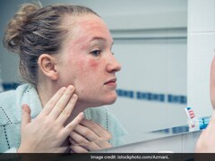 Atopic Dermatitis: 7 Tips To Manage Eczema Flare-Ups This Winter