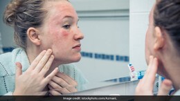 Tips To Prevent And Manage Eczema Flare Ups