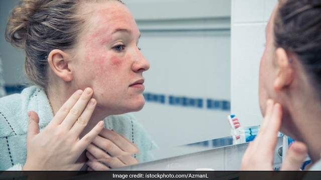 Tips To Prevent And Manage Eczema Flare Ups
