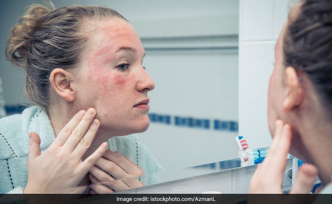 Tips To Prevent And Manage Eczema Flare Ups