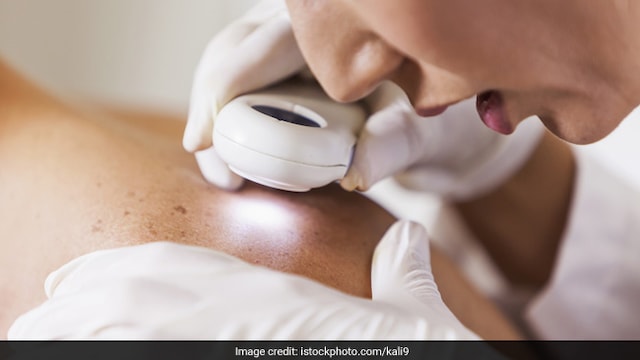 Unprotected sun exposure can lead to skin cancer