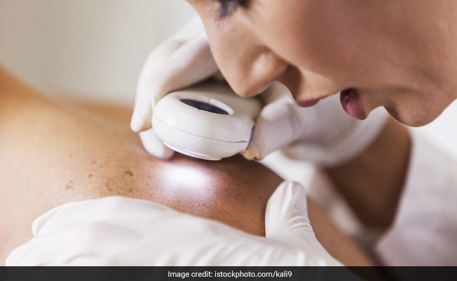 Unprotected sun exposure can lead to skin cancer