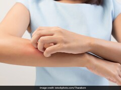 World Psoriasis Day 2024: Theme, History, Significance & Tips To Reduce Flare-Ups In Winter