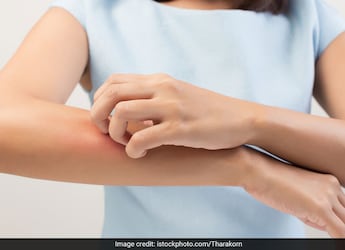 These Diet Tips Can Help Manage Psoriasis