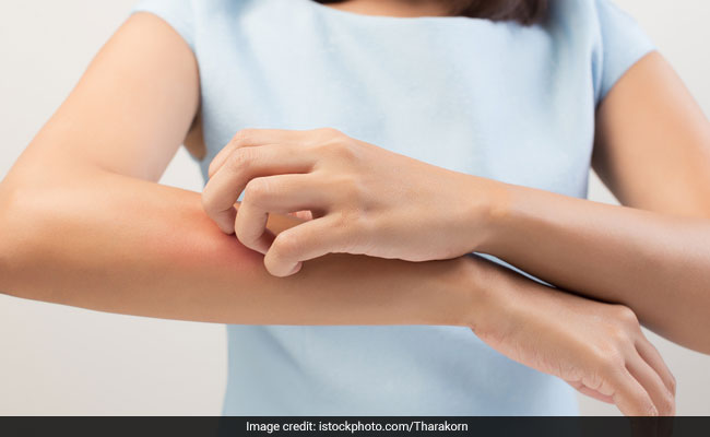 Psoriasis can cause itchiness and irritation on the skin