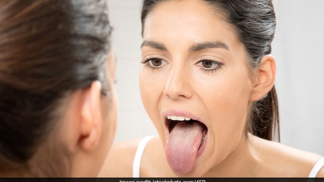 White tongue can be because of fever of dehydration