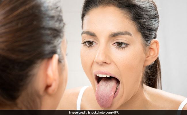 White tongue can be because of fever of dehydration