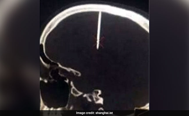 Man With Nail In Skull Has No Idea How It Got There