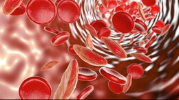World Sickle Cell Day 2024: Know Symptoms, Risk Factors And Complications For This Condition