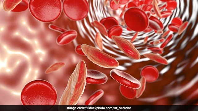 Sickle cell disease (SCD) is a group of blood disorders inherited by a child from its parents