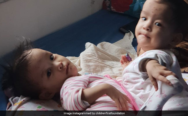 Bhutan's First Conjoined Twins To Be Evaluated Before Separation Surgery