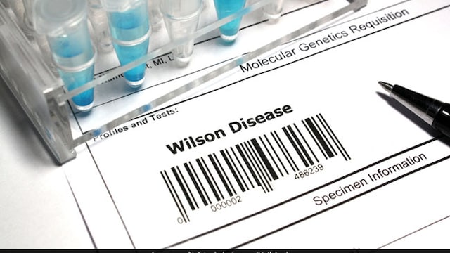Excess accumulation of copper in the body results in Wilson's disease