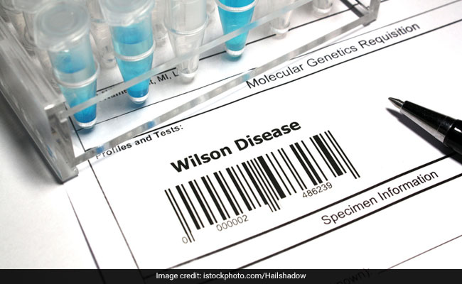 Excess accumulation of copper in the body results in Wilson's disease