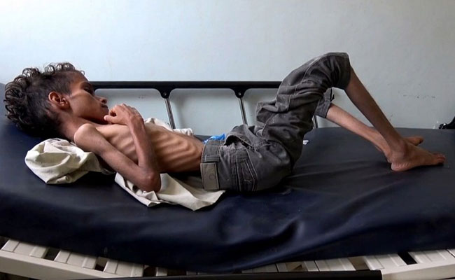 In Haunting Image Of Yemen War, A Starving Boy Is Too Weak To Cry