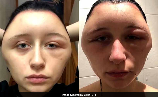 खूबसूरत दिखने के लिए लड़की ने किया बालों के साथ कुछ ऐसा, दोगुना हो गया सिर का साइज़