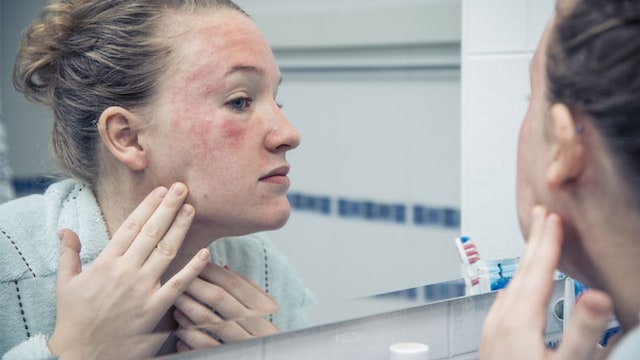 Dry skin is usually temporary and one often gets it in winter.
