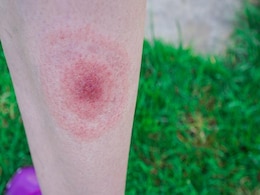 Over 14 Per Cent Of World Population May Have Had Lyme Disease, Finds Study Over 14 Per Cent Of World Population May Have Had Lyme Disease, Finds Study