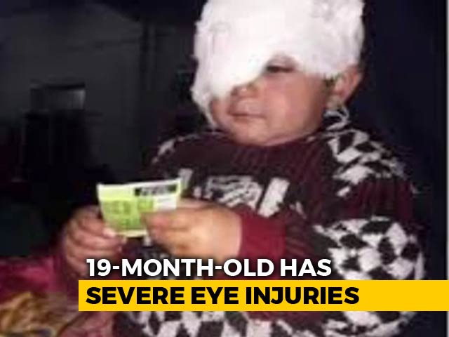 19-Month-Old, Kashmir's Youngest Pellet Survivor, Needs Several Surgeries