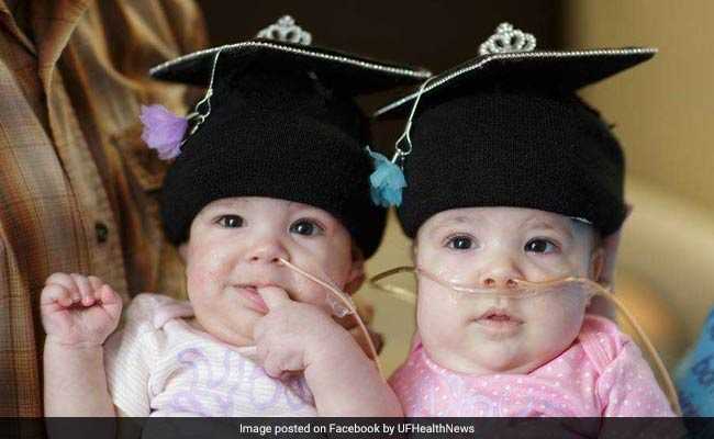 US Conjoined Twins Started Their Lives Together - But Are Going Home As 2