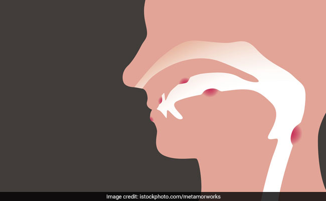Cancer: Signs & Symptoms of Mouth Cancer One Must Not Ignore