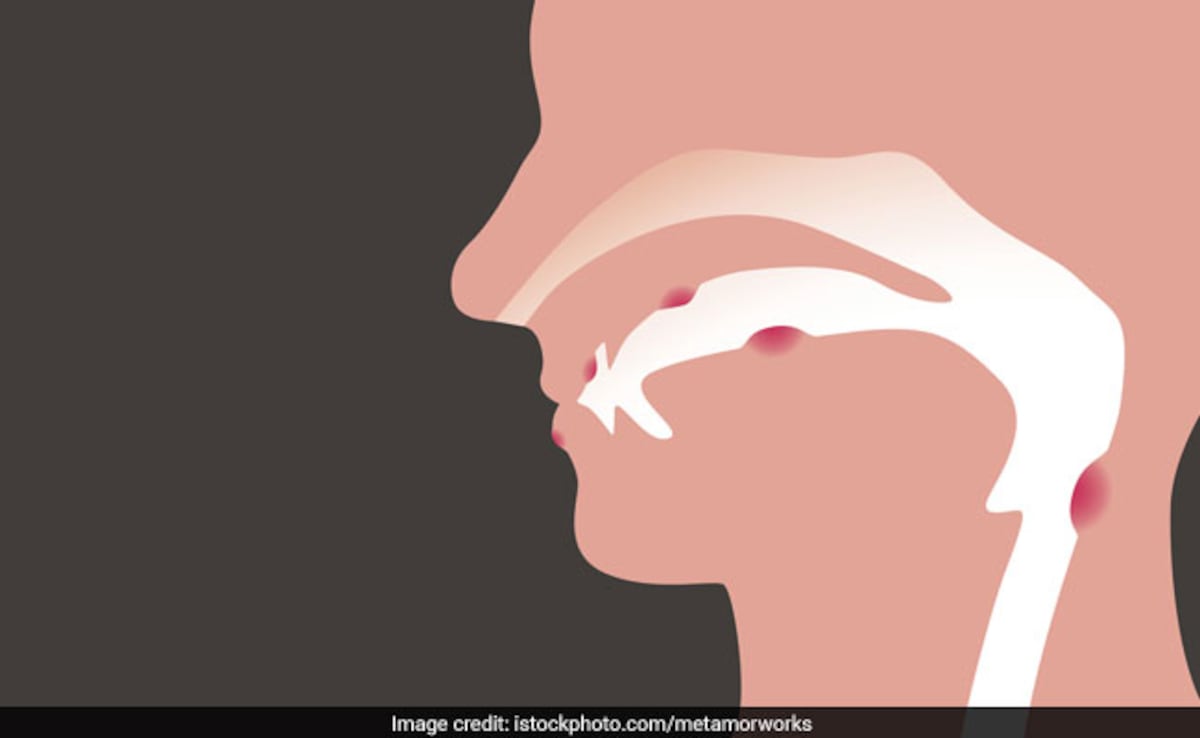 62% Mouth Cancer Cases In India Caused By Alcohol, Smokeless Tobacco Use: Study