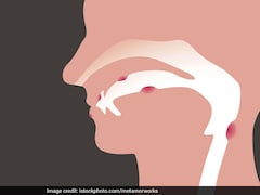 62% Mouth Cancer Cases In India Caused By Alcohol, Smokeless Tobacco Use: Study