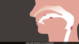62% Mouth Cancer Cases In India Caused By Alcohol, Smokeless Tobacco Use: Study
