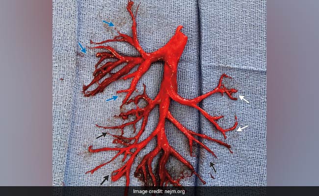 Blood Clot Formed In Exact Shape Of A Lung Passage. Man Coughed It Out