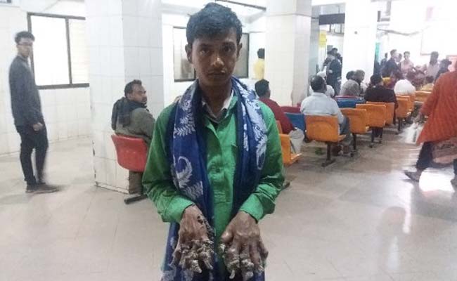 Bangladesh's "Tree Man" Says "Growths Even In New Parts of Feet, Hands"
