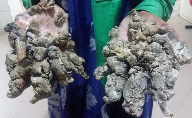 इस शख्‍स के हाथ और पैर पर उग आती हैं पेड़ जैसी शाखाएं, कहा- 'प्‍लीज, मेरे हाथ काट दो'