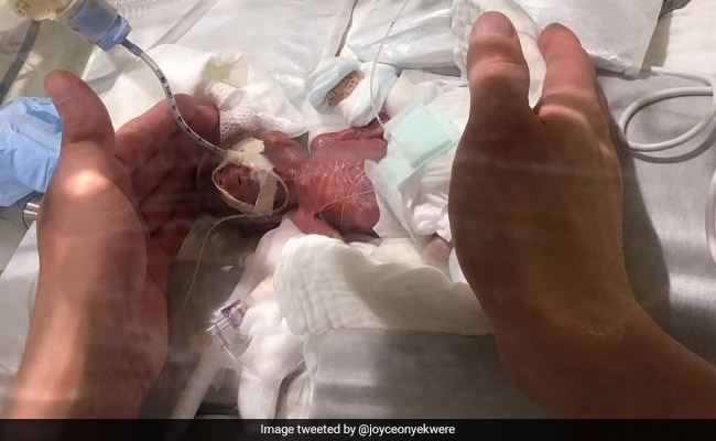 ये है दुनिया का सबसे छोटा बच्चा, 20 हफ्ते में लिया जन्म, वज़न सिर्फ 268 ग्राम, देखें Photos