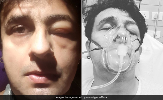 सोनू निगम को आखिर ये हुआ क्या, सूज गई आंख, फोटो हुई Viral