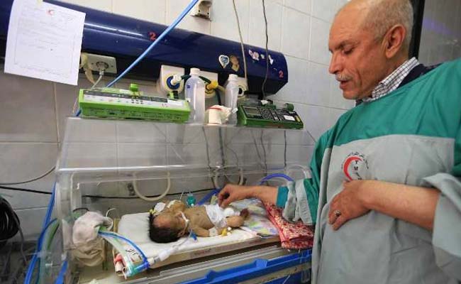 Yemeni Conjoined Twins Die Due To Lack Of Medical Equipment