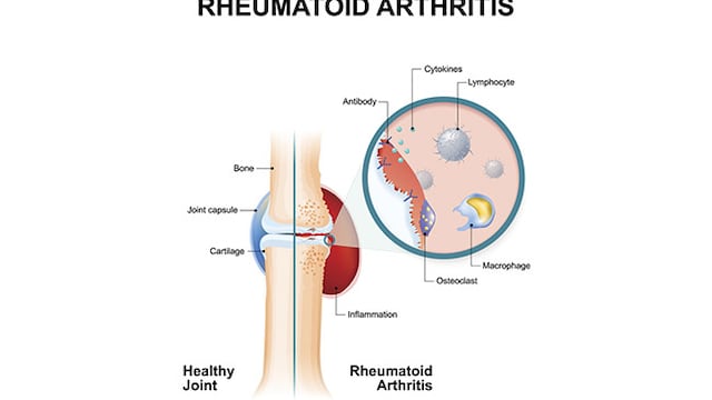 This arthritis occurs when the body's defense system attacks your own body cells.