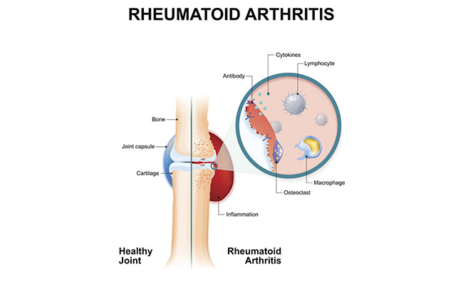 This arthritis occurs when the body's defense system attacks your own body cells.