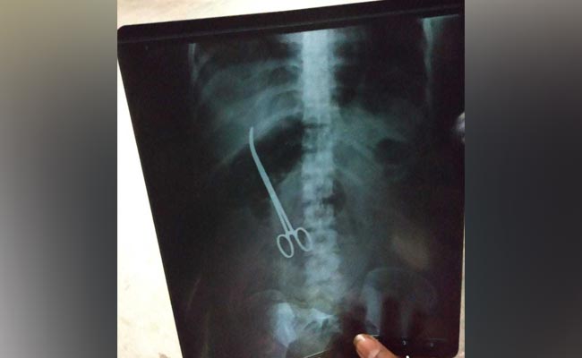 Surgeons Left Forceps In Hyderabad Woman. X-Ray Found It After 3 Months